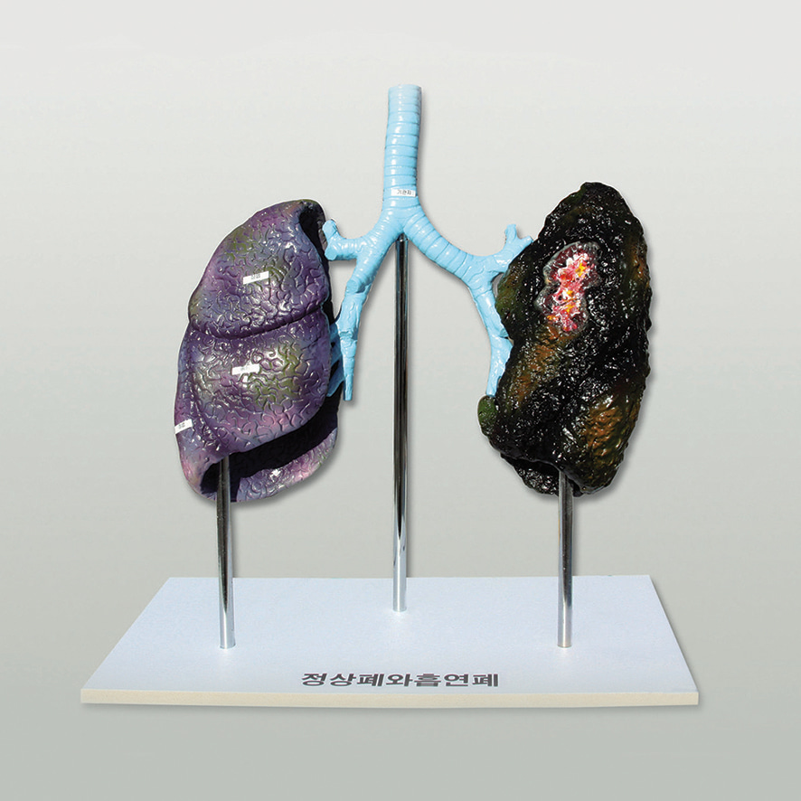 폐의 비교(정상폐와 흡연폐)-CX6325